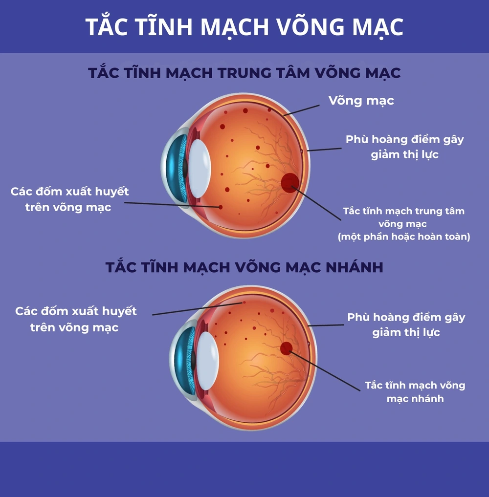 Tắc tĩnh mạch võng mạc